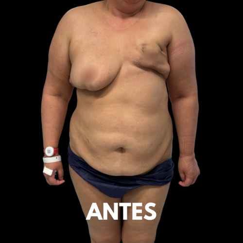 Reconstrucción mamaria + Transplante de ganglios linfáticos (TLNV) antes